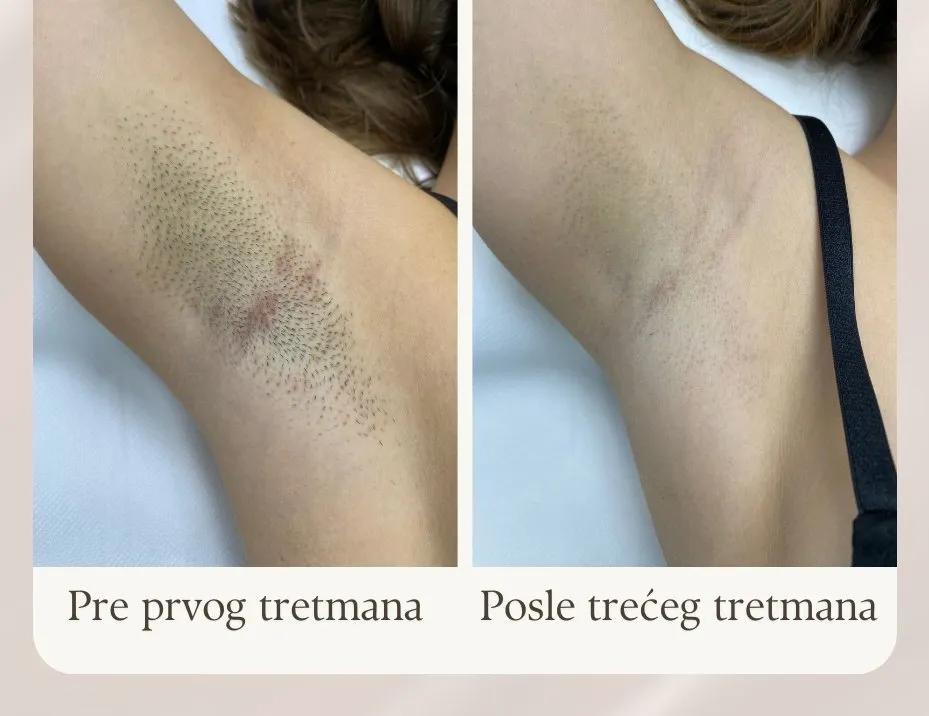 Pazuh pre prvog i posle trećeg tretmana laserske epilacije